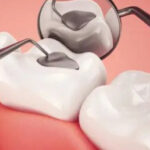 منظور از ایمپلنت دیجیتال چیست ؟