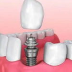 منظور از ایمپلنت دیجیتال چه است ؟